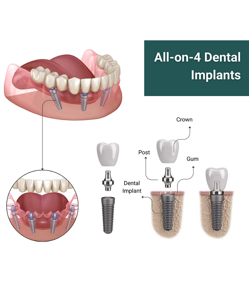 All-on-4 Implants Las Vegas, NV