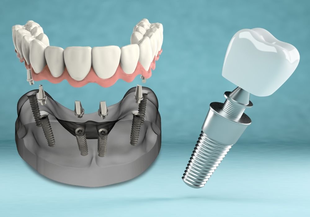 Full Mouth Dental Implants Las Vegas