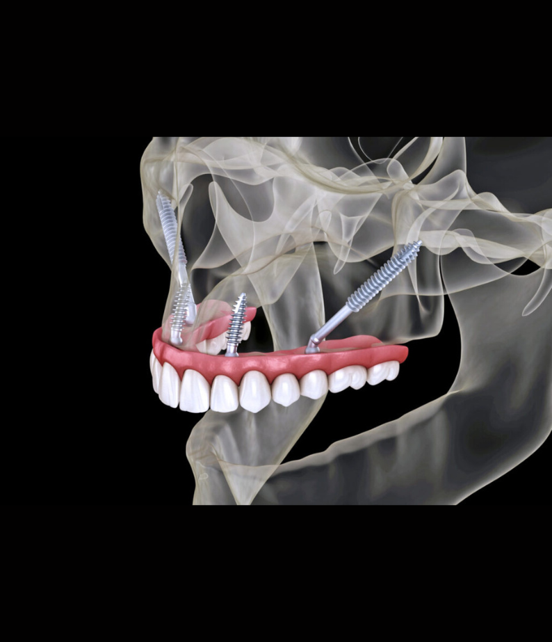 Zygomatic Implants  Las Vegas, NV