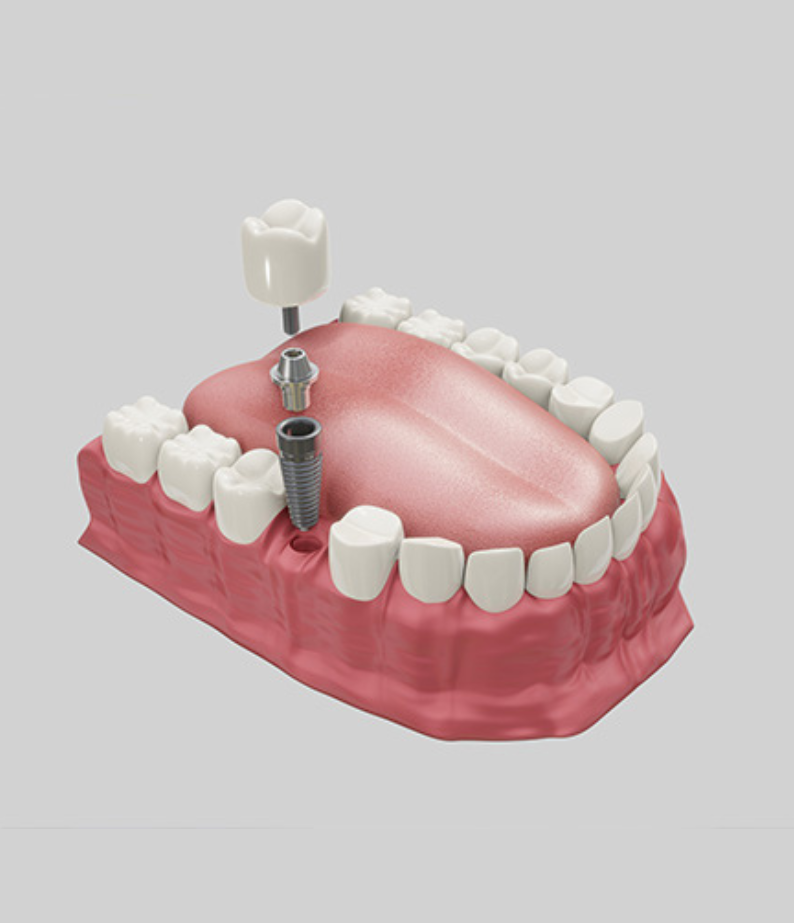 Immediate Load Implants (Teeth in a Day)  Las Vegas, NV